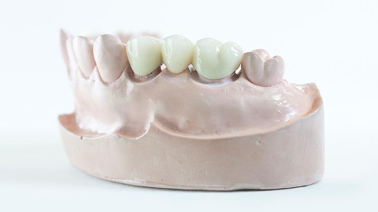 Dental bridge